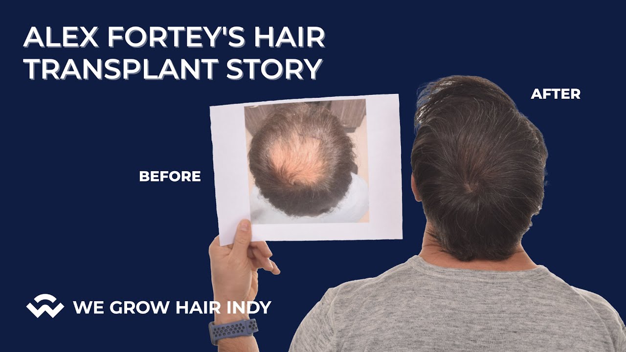 Alex Fortey's Hair Transplant Story
