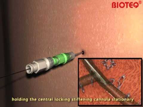 Bile Ducts & Duodenum--NK2 KIT-Using Metal Stiffening Cannula Method.mpe