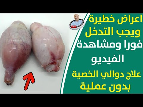 عندك الم في الخصية طرق علاج دوالي الخصية بدون جراحة بطريقة فعالة ومجربة اعراض دوالي الخصية