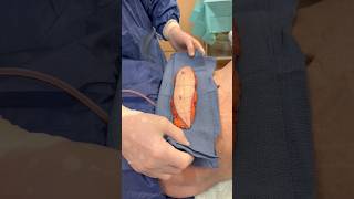 A mini tummy tuck teaser! #bodytransformation #plasticsurgery #male #body #tummytuck #monday