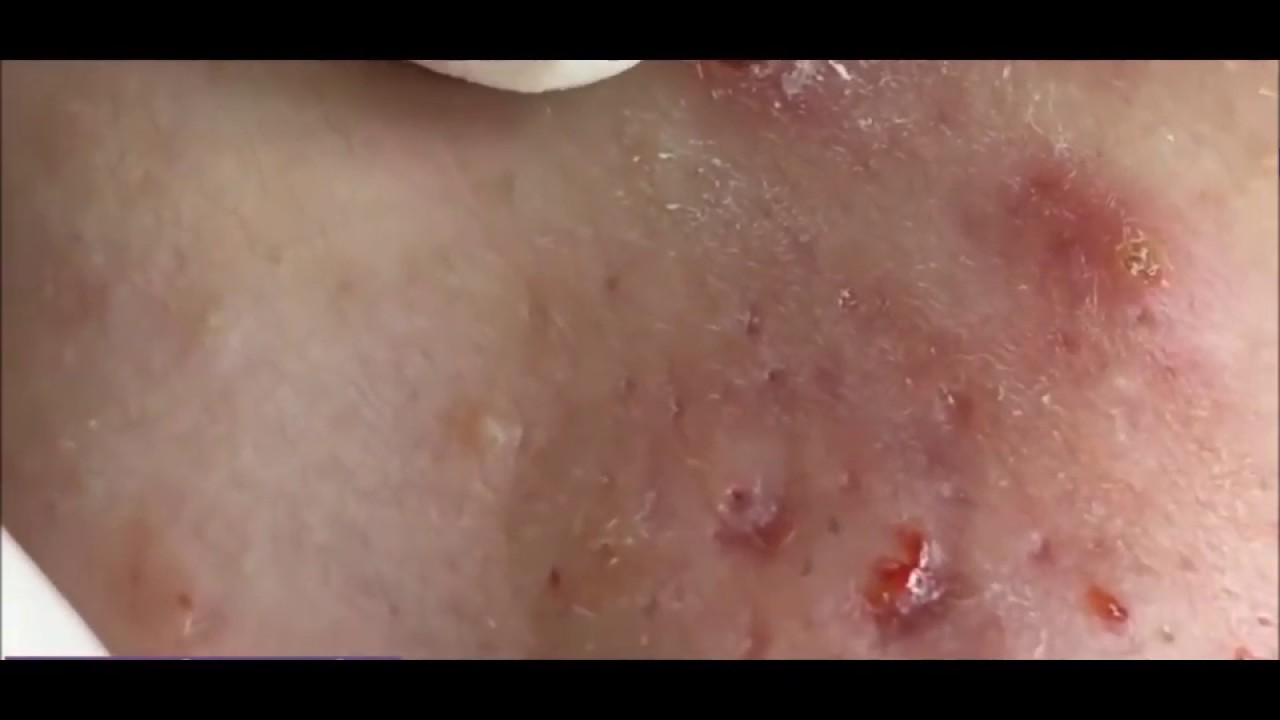 Relaxing Pimple Extraction I Acne I 2020 YouTube