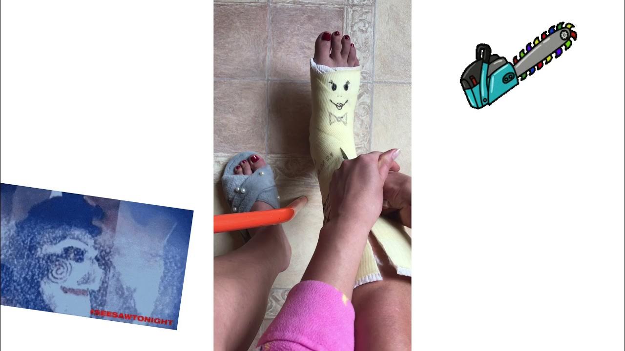 можно снимать гипс раньше срока