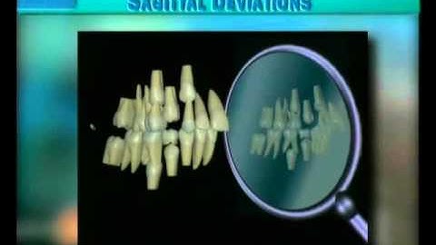 Clip 32: Lateral View of Development of Severe Class II/1 Malocclusion