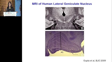 AIOC2019 - GP001 - Structural and Functional Correlation in the Diagnosis of Glaucoma