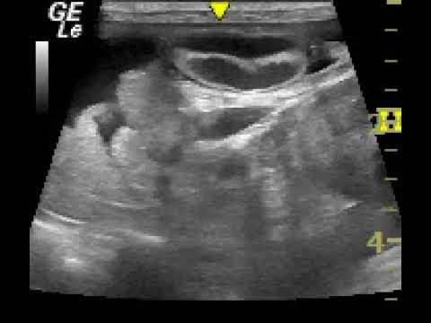 Ultrasonography of congenital portosystemic shunt with interruption of the portal vein