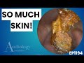 Extreme Ear Wax Removal | So Much Skin & Wax! - EP1194