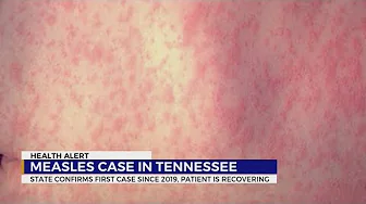State confirms 1st measles case in TN since 2019 thumbnail