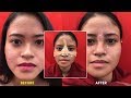 Girl from Tripura, India Gets a Complete Face Makeover Surgery - Dr Sunil RIchardson