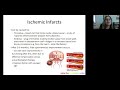 Neuroanatomy and functional sequelae of stroke part 1  health4theworld academy