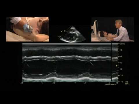 M-Mode Measurement of the Left Ventricle