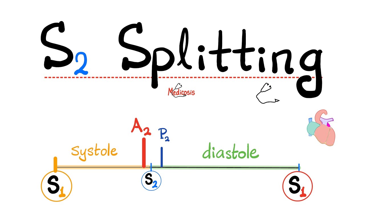 Splitting of Second heart Sound (S2) - A2, P2 - Aortic, Pulmonic -Wide ...