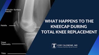 What Happens to the Kneecap during Total Knee Replacement