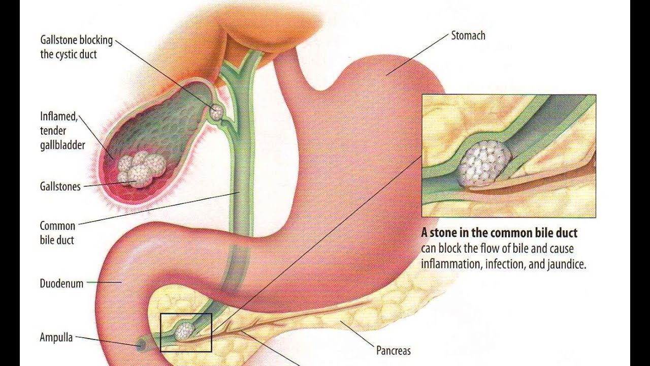 Желчный пузырь как удалить желчь. ЖКБ камни желчного пузыря. Камни в желчевыводящих протоках. Проток желчного пузыря камень. Конкременты желудочного пузыря.