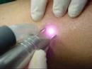 Tratamiento Laser contra las Varices