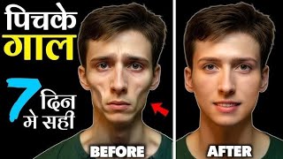 Pichke Gaal Kaise Fulaye पचक गल जलद कस फलए Gaal Mote Kaise Kare