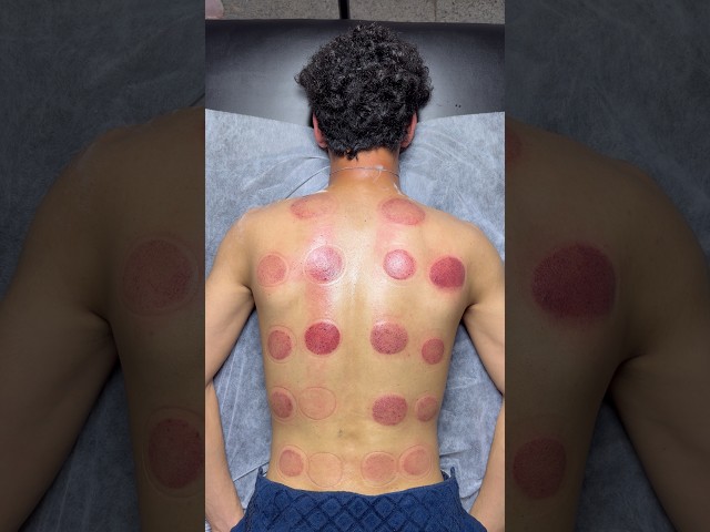 "ASMR" vip cupping 😍#shorts #asmr #youtubeshorts #cuppingtherapy #viral