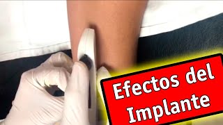 Porque No Reglo Si Uso Implante Subdérmico