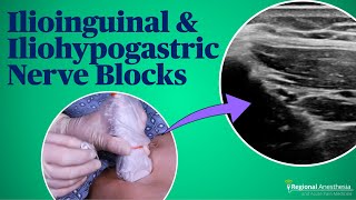 Ultrasound-guided Ilioinguinal and Iliohypogastric Nerve Blocks screenshot 4