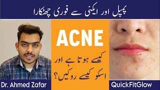 How To Remove Pimples Overnight | Acne Treatment | Pimple Khatam Karne Ka Tarika | Urdu/Hindi