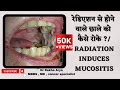         radiation induces mucositis