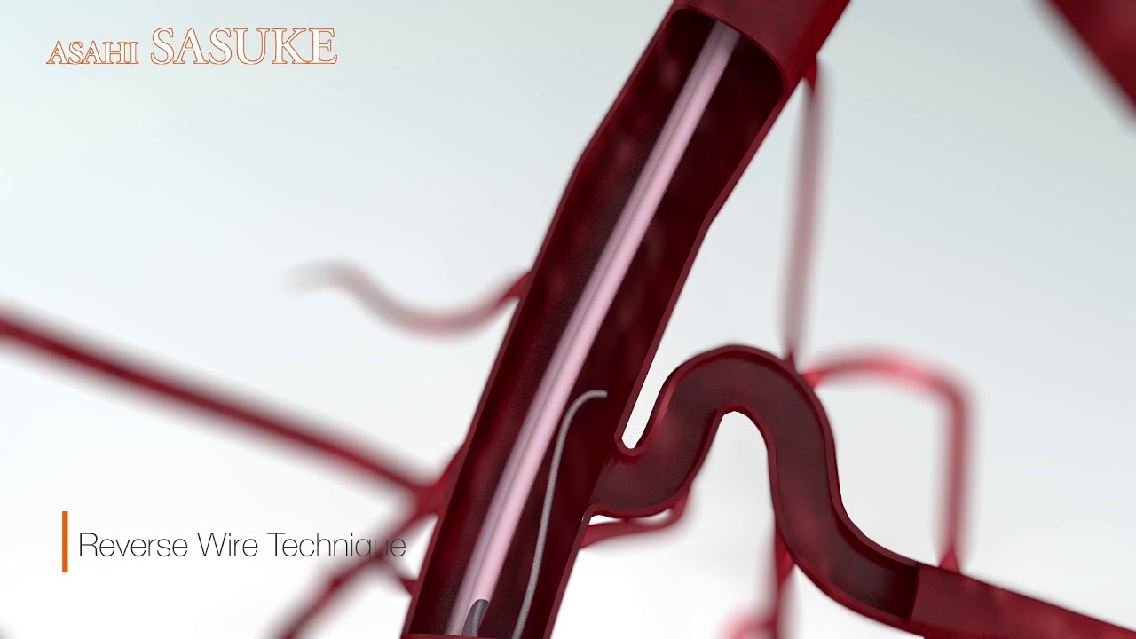 Reverse Wire Technique YouTube