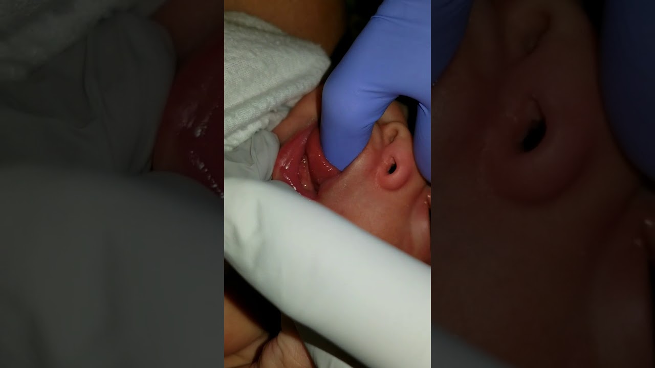 Оценка сосания у младенца