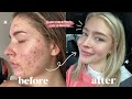 MY FULL ACCUTANE JOURNEY | side effects, cost, will it come back?