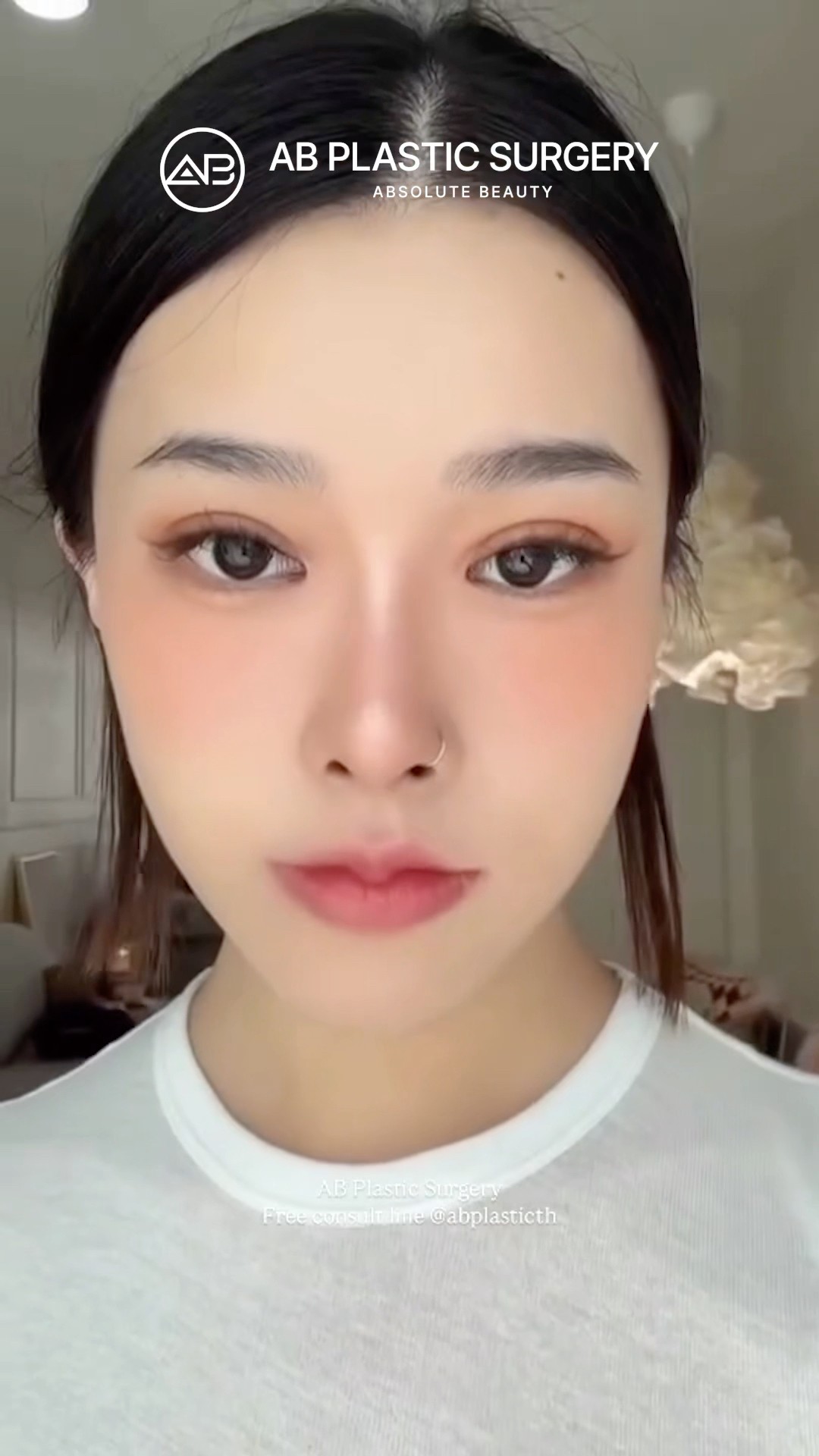 Facial Contouring, Eye Surgery & Facelift – Her Whole Look Changed #shorts