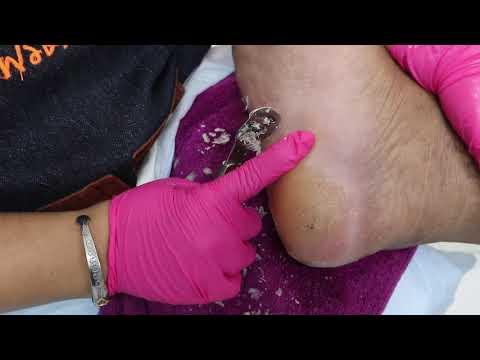 EP_1223 Foot skin removal 👣 ข้อดี-ข้อเสียของการขูดส้นเท้า 😷 (This clip from Thailand)