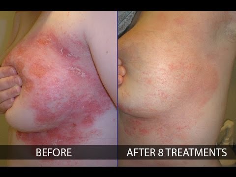 Childhood rashes, skin conditions and infections: photos ...