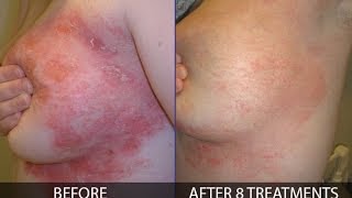 Dr. franziska ringpfeil specializes in the treatment of psoriasis and
offers her services philadelphia mainline pa. she talks here about how
to re...