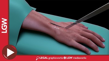 Right Ring Finger Trigger Release 3D Animation