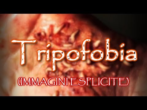 Video: Tripofobia: Cause, Sintomi, Trattamento