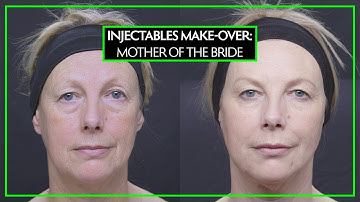 Injectables Make-Over For the Mother Of The Bride