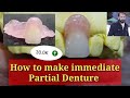 Immediate Removable Partial Denture || Removable partial Denture || Without clasp acrylic Denture