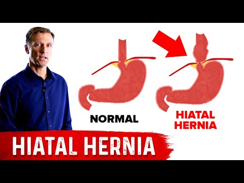 Video: Hiatal Hernia Natural Treatment + Symptom, Orsaker Och Kost