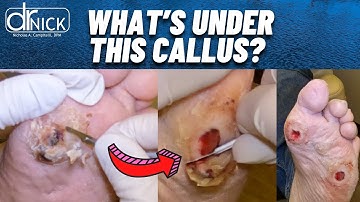 SHAVING A CALLUS TO REVEAL A POSSIBLE INFECTION? Dr. Nick Campitelli