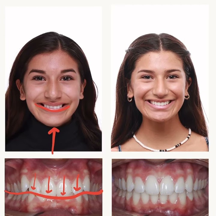 How Do You Fix an Overbite? - Burke & Beckstrom Orthodontics