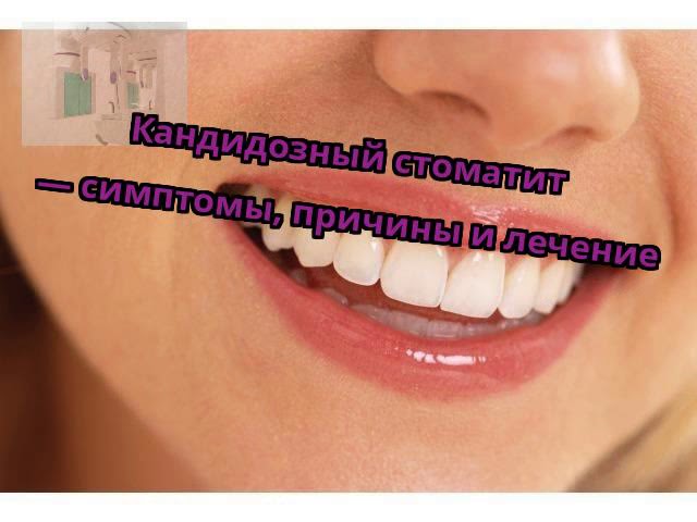 Кандидозный стоматит — симптомы, причины и лечение