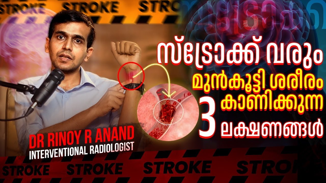 സ്‌ട്രോക്ക്‌ വരും ശരീരം വളരെ മുൻകൂട്ടി കാണിച്ചുതരുന്ന മൂന്നു ലക്ഷണങ്ങൾ പരിഹാരം  Stroke / Podcast