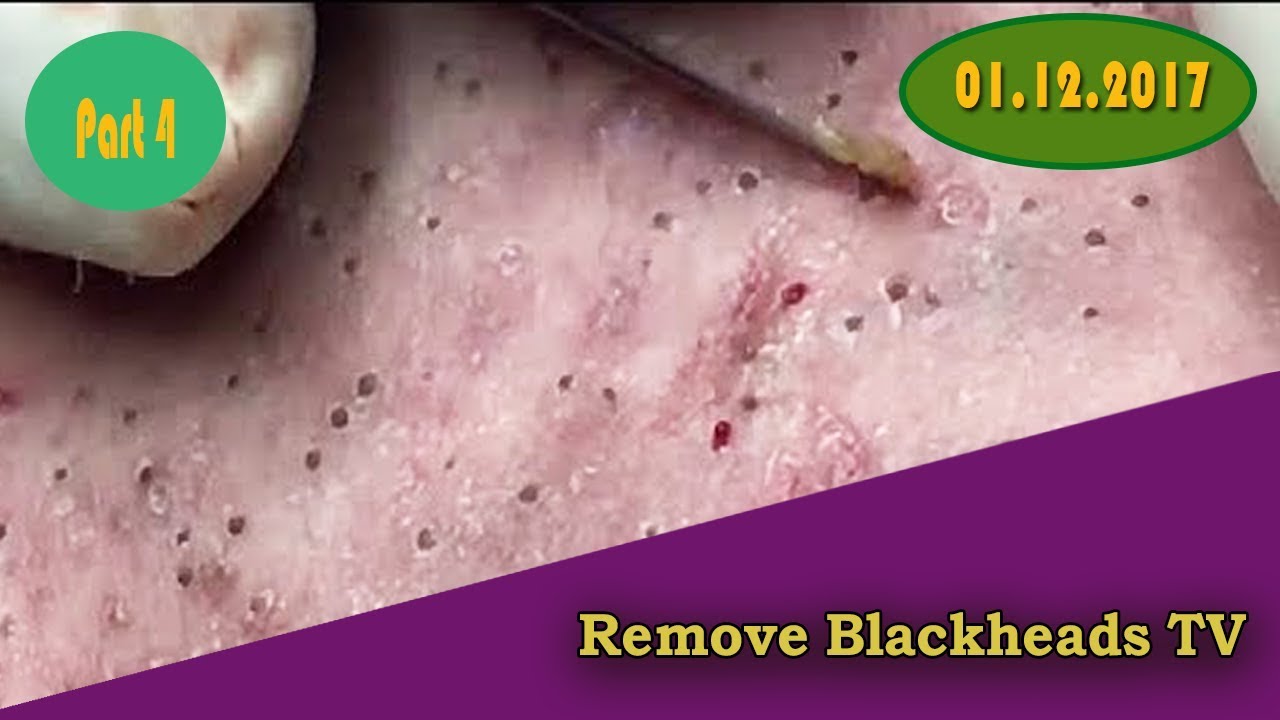 Acne And Blackhead Popping Blackheadscysts Blackheads Removal On Face