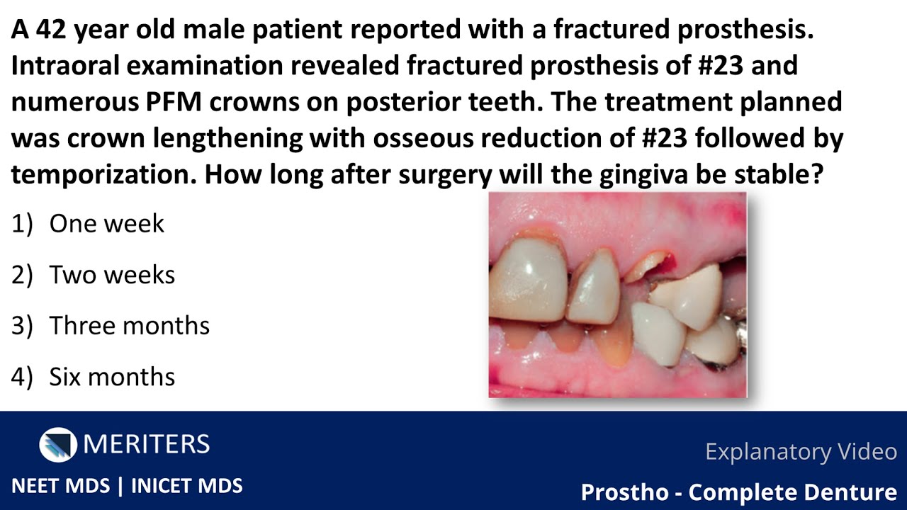 NEET MDS INICET Prostho Complete Denture Explanatory Video