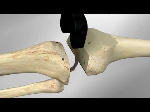 Vanguard® ID Total Knee Surgical Technique Animation