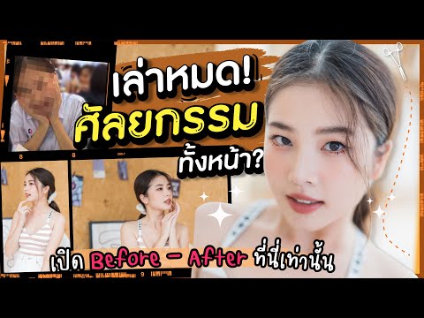 ติดฝน | เล่าหมด! ศัลยกรรมทั้งหน้า? เปิด Before - After ที่นี่เท่านั้น | Sananthachat