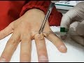 Finger | Parmak | Piercing Delimi İyileşme Süresi  ??