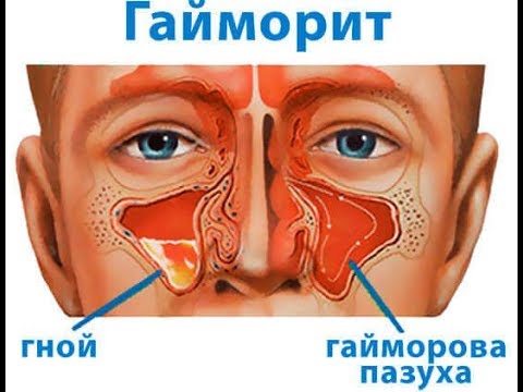 Избавление от насморка и гайморита за 5 минут