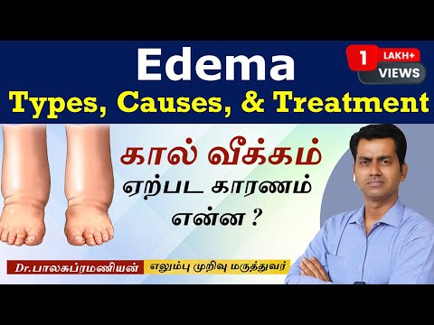 கால்வீக்கம் ஏற்பட காரணம் என்ன? Edema, Causes, Signs and Symptoms, Diagnosis and Treatment in tamil