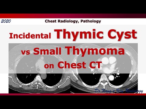 Incidental Thymic Cyst vs Small Thymoma, CT