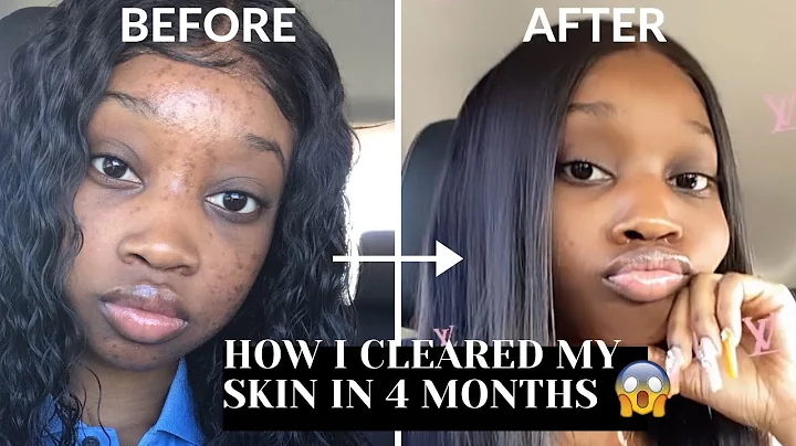 HOW I CLEARED MY SKIN/ACNE IN 4 MONTHS 😱 | FT. ForMySelfBeauty