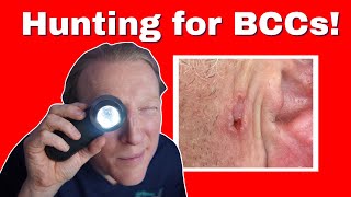 BCC: Basal Cell Carcinoma Skin Cancer: What You NEED to KNOW screenshot 3